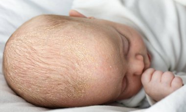Bebeğin kafasında seborrheic dermatitis kabukları var. Saçında deri dökülmesi olan çocuk, yeni doğmuş cilt sorunları.