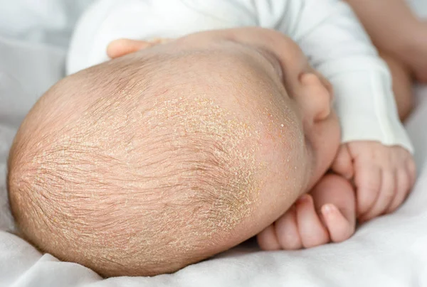 Dermatitis Seborreica Costras Cabeza Del Bebé Niño Con Seborrea Cabello Fotos de stock libres de derechos