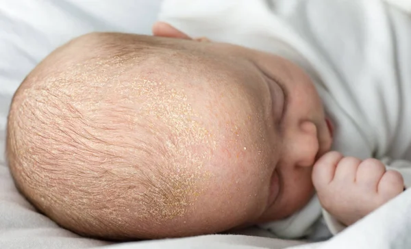Seborrheic Dermatitis Korstjes Het Hoofd Van Baby Kind Met Seborrhea Stockfoto