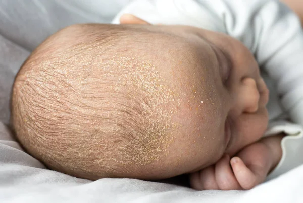 Seboroická Dermatitida Kůrky Hlavě Dítěte Dítě Seboreou Vlasech Novorozenecké Kožní Royalty Free Stock Obrázky