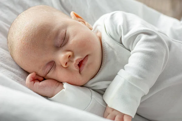 Dermatitis Seborreica Cara Del Bebé Niño Recién Nacido Dormido Con Imagen de archivo