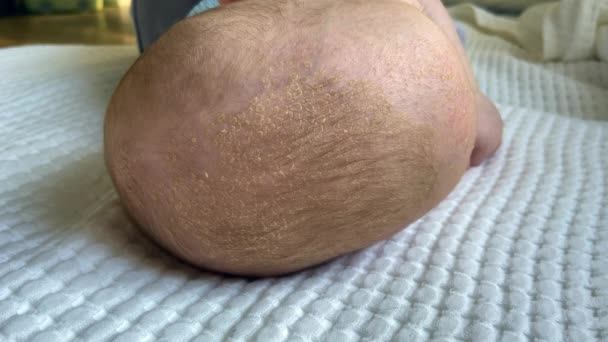 Bebé recién nacido seborrea problemas de la piel alergia o erupción en la cabeza y la frente — Vídeo de stock