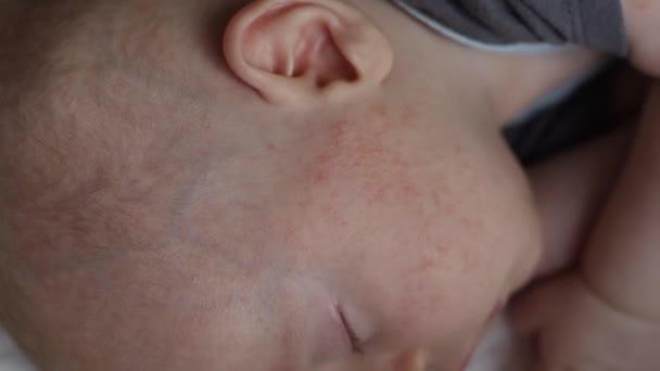 Alergie atopická dermatitida ekzém vyrážka na miminka tvář tváře a paže zblízka pohled — Stock video