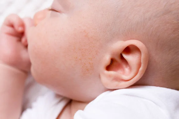 Bebé dermatitis infantil piel alérgica — Foto de Stock