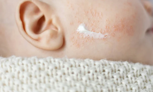 Zalf of crème aangebracht op de wang van baby dermatitis Stockfoto