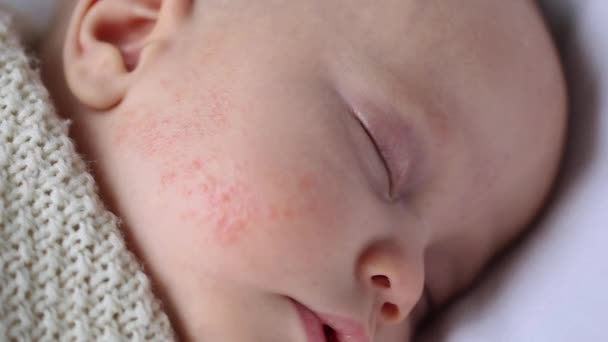 Säugling schläft mit allergischem Hautausschlag auf der Wange — Stockvideo