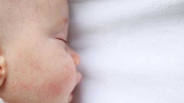Спящий младенец с атопическим дерматитом на щеке — стоковое видео