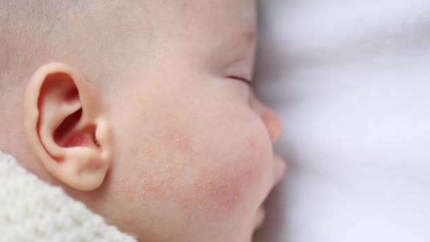 Infant baby with red dermatitis rash on cheek — Stock Video