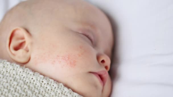 Bebé con dermatitis roja erupción en la mejilla — Vídeos de Stock