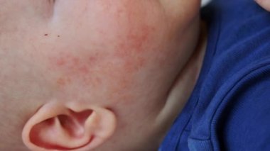 Kırmızı acele sivilceler bebek yanağında alerjik deri iltihabı