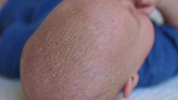 Baby baby wieg cap of seborrhea dermatitis — Stockvideo
