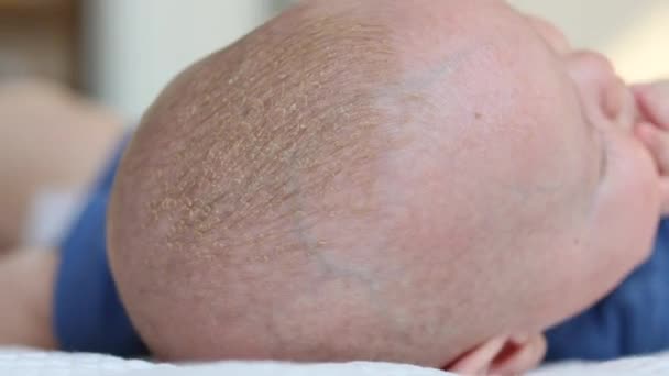 Крупный план крышки колыбели или себореи на голове младенца — стоковое видео