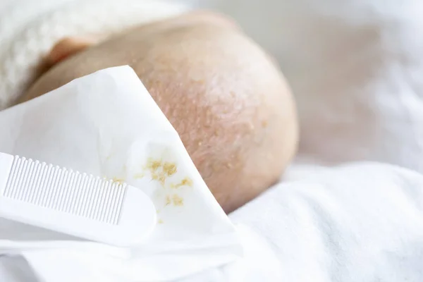 Costras seborreicas de la cabeza de los bebés sobre tejido blanco — Foto de Stock