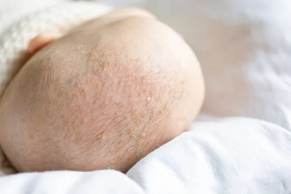 Seborrheïsche dermatitis bij baby 's hoofdhuid Rechtenvrije Stockafbeeldingen