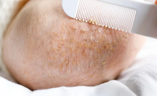 Eliminación de la tapa de la cuna del tratamiento de la dermatitis seborreica Fotos de stock