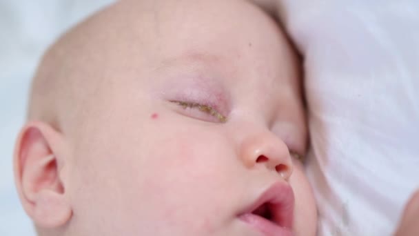 Portrait de bébé endormi avec des yeux avec conjonctivite croûtes oeil rose en vue rapprochée du nouveau-né — Video