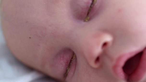 Vista de cerca de los ojos de los bebés dormidos con costras conjuntivitis ojo rosa en vista de cerca recién nacido — Vídeo de stock