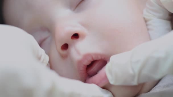 Kinderarts tandarts controleren mond van een slapende baby met twee witte melktanden uitgebarsten — Stockvideo