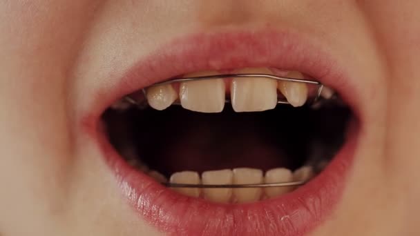 Smile With Braces On Teeth Stock Video C Utlanovd 96932446