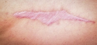 Sırtında hipertrofik yaralar (cicatrix), kas dokusu nakli, kolajen sentezi. Yakın plan. Seçici odak.