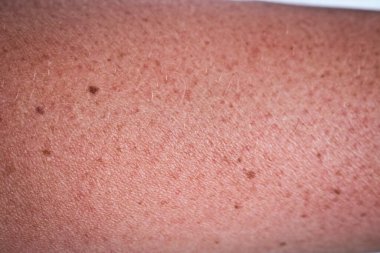 Elin derisi güneşte yandı. Bir kadının el derisi yüzülmüş. Cilt güneş yanığı..