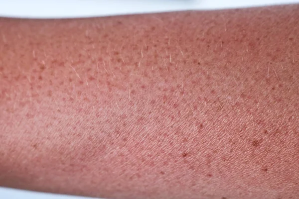 Skin Hand Burnt Sun Reddened Skin Woman Hand Close Sunburn — Stock Photo, Image