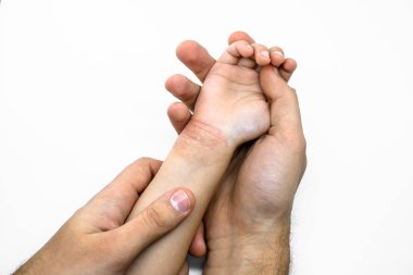 Bir erkeğin eli bir çocuğun elini tutar. Kırmızı kuru deri alerjisi. Yakın plan. Teftiş