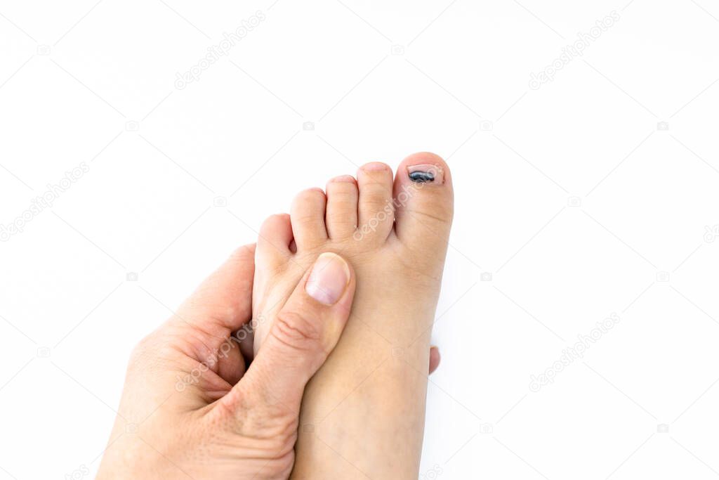 Hematoma under the fingernail of the child's toe. A woman's hand holds a child's leg with a bruised finger