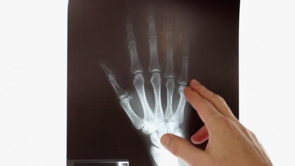 Nahaufnahme Die Hand Des Arztes Zeigt Das Röntgenbild Der Hand — Stockvideo