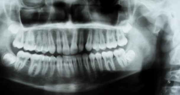 Raio Horizontal Rastreamento Dentário Dentes Humanos Ossos Face Humana Visão — Vídeo de Stock