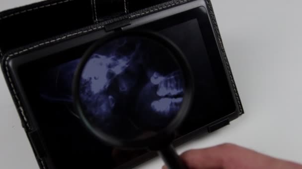 Крупным Планом Рука Доктора Держит Увеличительное Стекло Осмотре Рентгена Планшете — стоковое видео