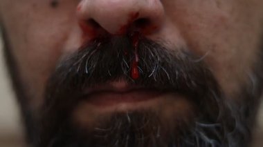 Sakallı bir adamın burnundan kan damlayan bir damla burnu vardır. Yakın plan.