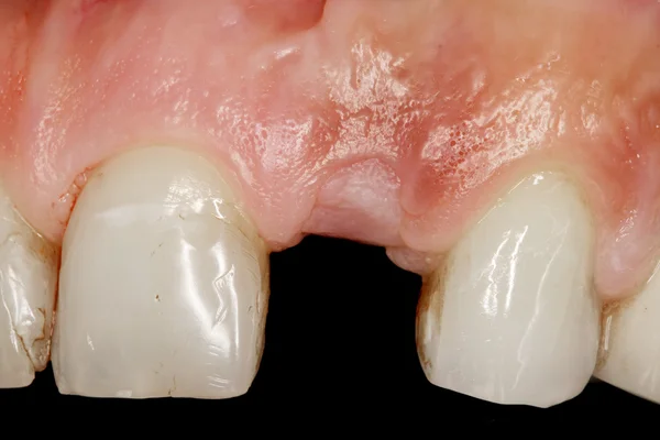 牙外科植入物视图 — 图库照片
