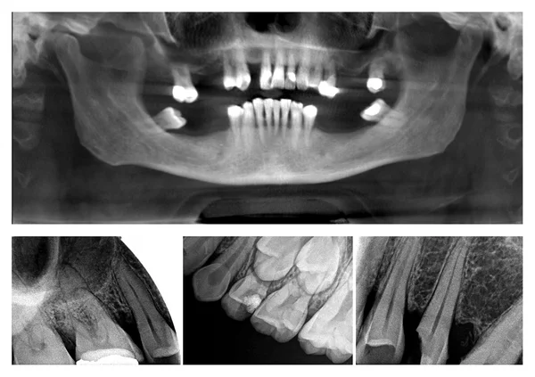 Colagem de raios X dental — Fotografia de Stock