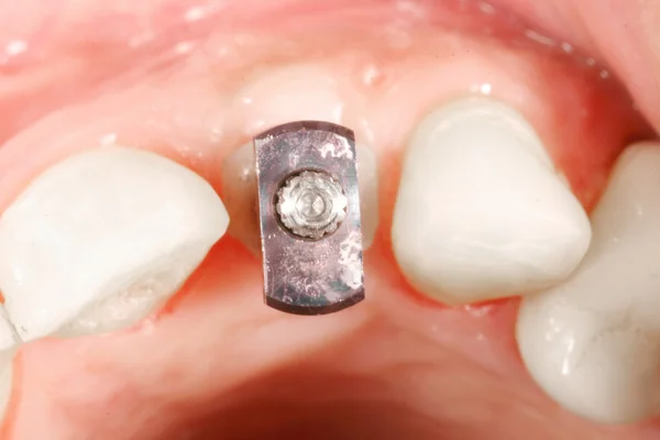 diş cerrahi implant görünümü