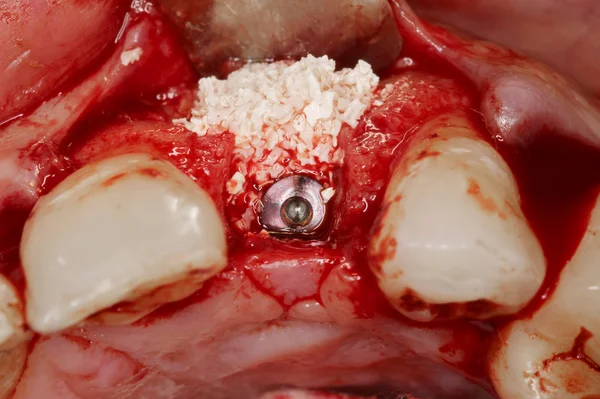 牙外科植入物视图 — 图库照片