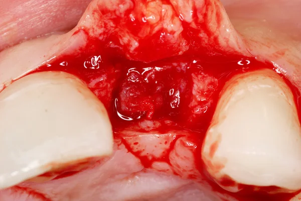牙外科植入物视图 — 图库照片
