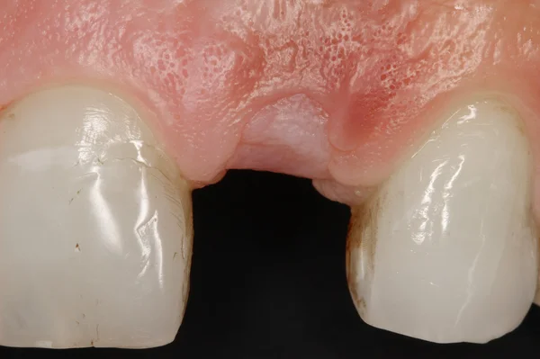 牙外科植入物视图 — 图库照片