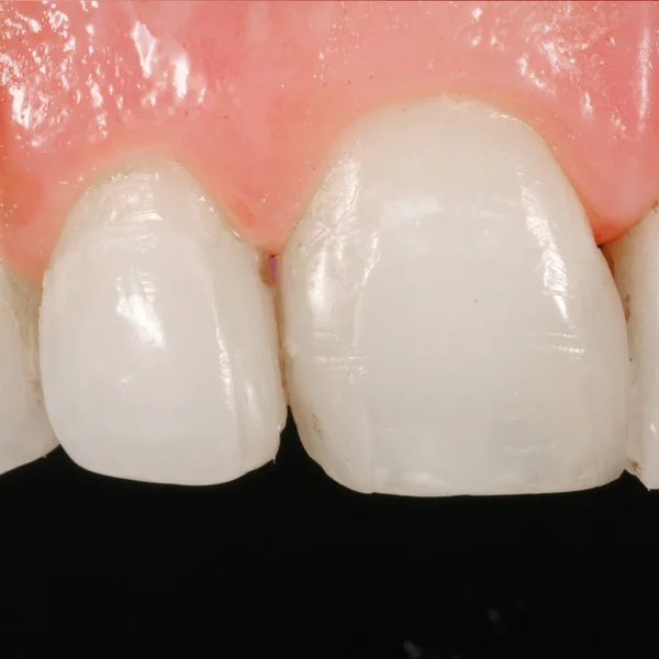Diş surjery implant görünümü