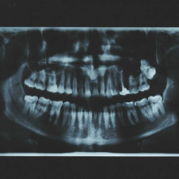 Imagen de rayos X dentales con dientes — Foto de Stock