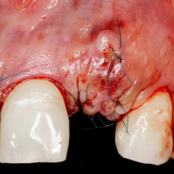 Προβολή εμφύτευμα οδοντιατρική surjery — Φωτογραφία Αρχείου