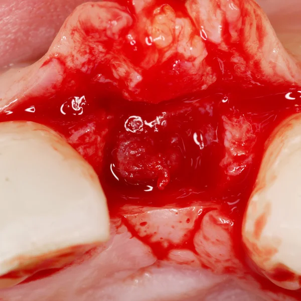 Surjery 牙科植入物视图 — 图库照片