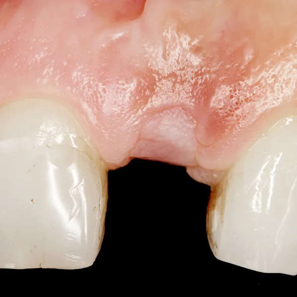 Dental surjery implant widok — Zdjęcie stockowe