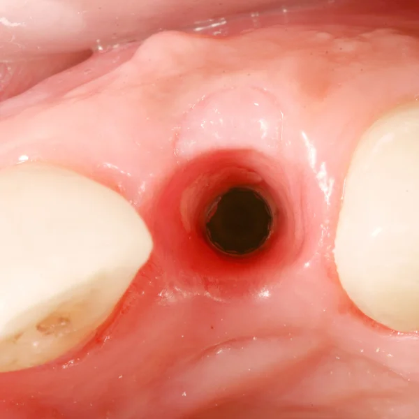 Vista del implante de cirugía dental —  Fotos de Stock