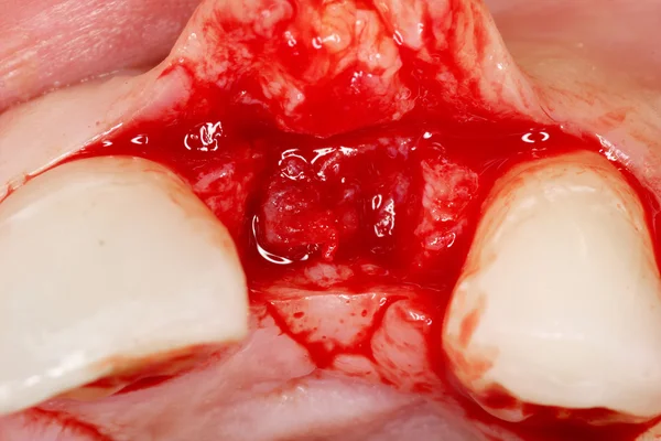 Cirurgia dentária vista implante — Fotografia de Stock