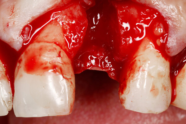 Real dental implant surgery