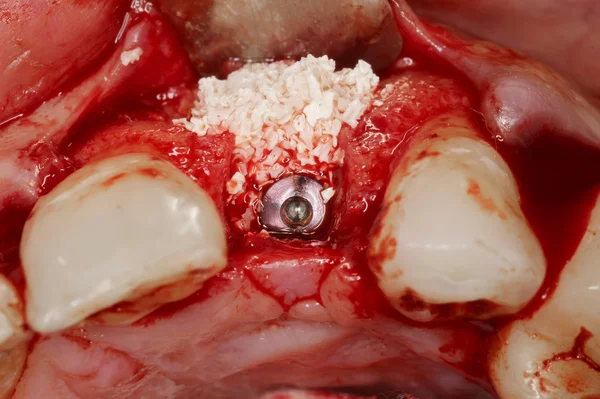 Cirurgia de implante dentário real — Fotografia de Stock