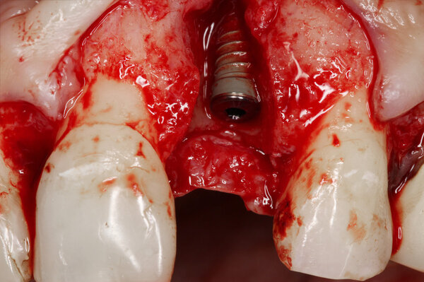 Real dental implant surgery