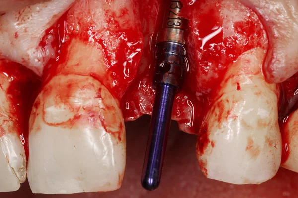 Cirugía de implantes dentales reales — Foto de Stock