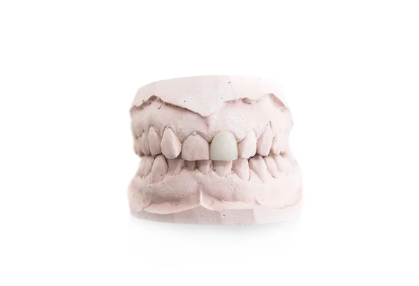 Modello di protesi dentaria in clinica dentale — Foto Stock